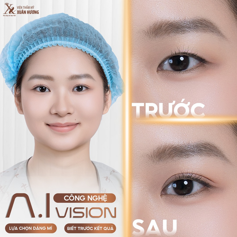 Cắt mí mắt công nghệ AI VISION tại Viện thẩm mỹ Xuân Hương